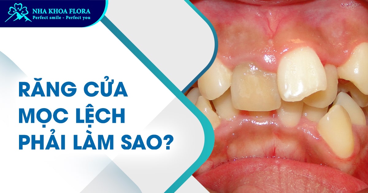 Răng cửa mọc lệch: Nguyên nhân, Tác hại và Cách điều trị