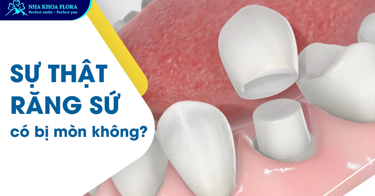 Răng sứ có bị mòn không? Bí quyết chăm sóc răng sứ bền đẹp