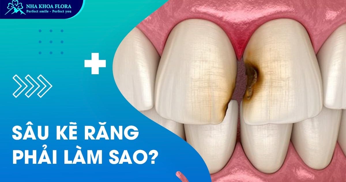 Sâu kẽ răng là gì? Có nguy hiểm? Cách điều trị