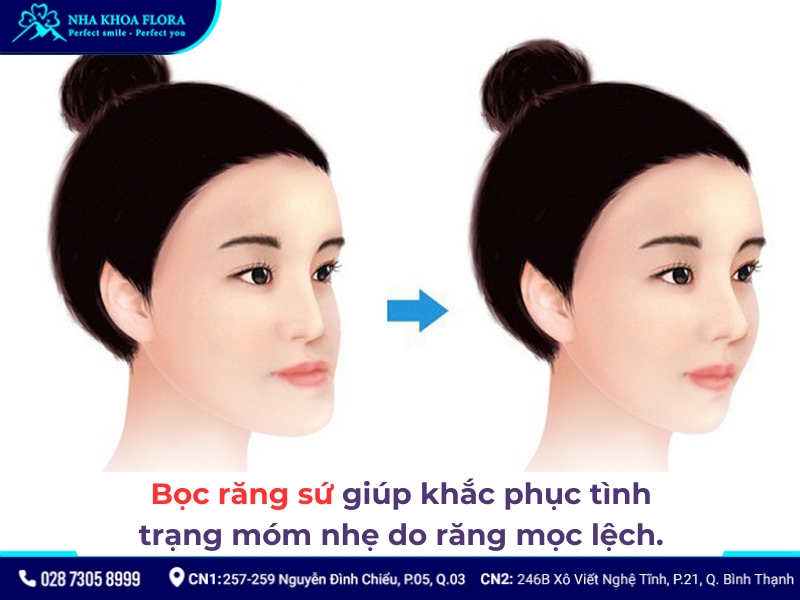 bọc răng sứ có hết móm không