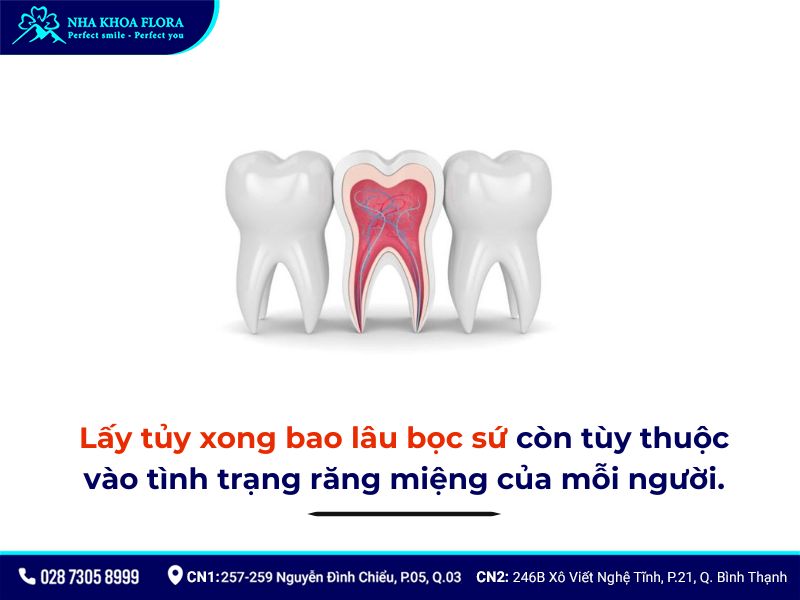 bọc răng sứ có lấy tủy không