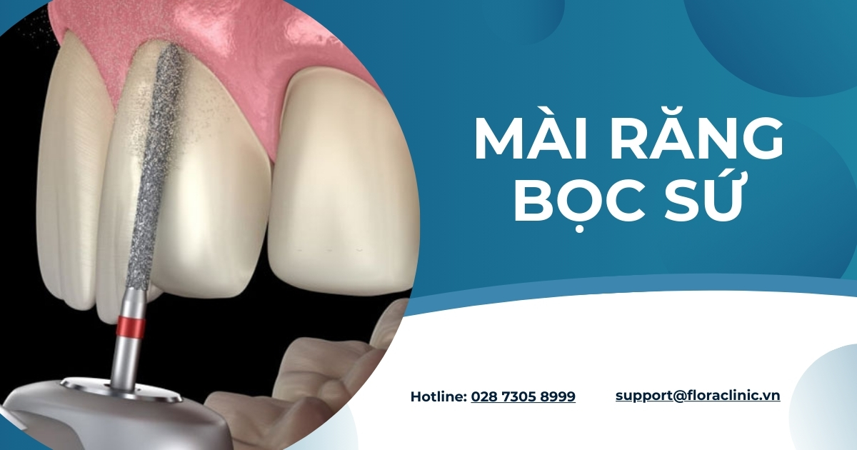 Mài răng bọc sứ có đau không? Mất bao lâu? Giá bao nhiêu?