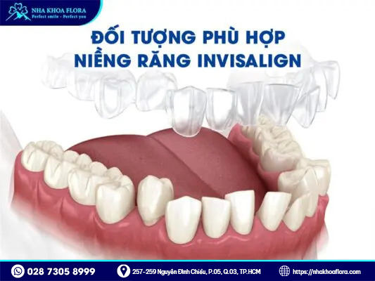 Niềng răng trong suốt Invisalign 2