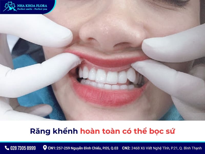 bọc răng sứ khểnh