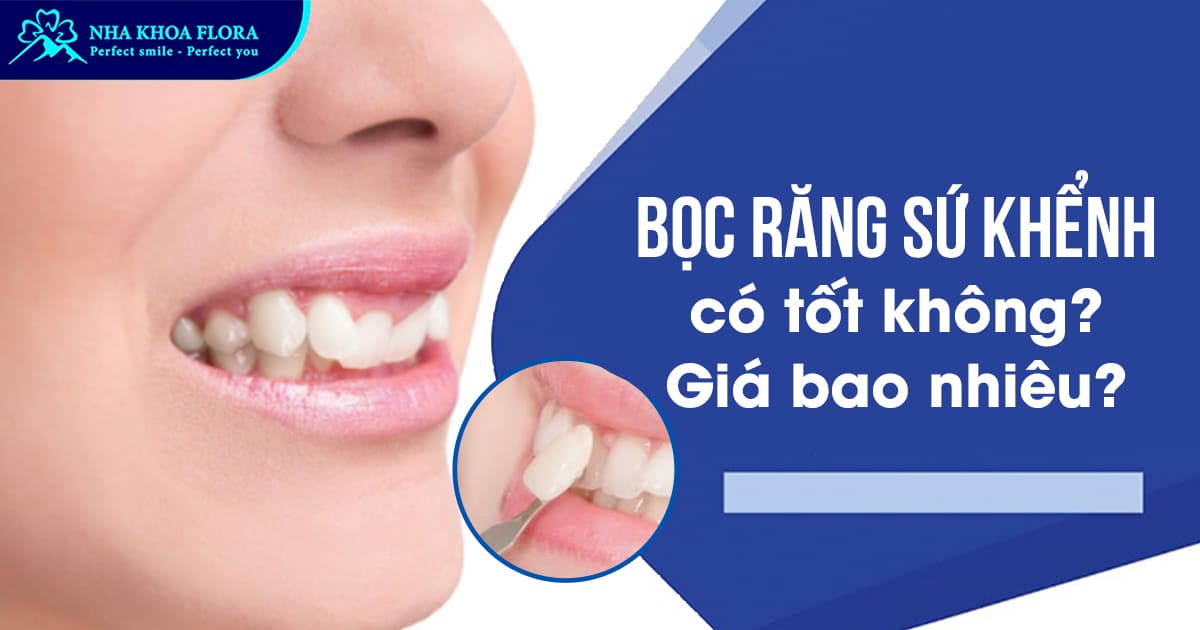 Bọc răng sứ khểnh là gì? Có tốt không? Giá bao nhiêu tiền?