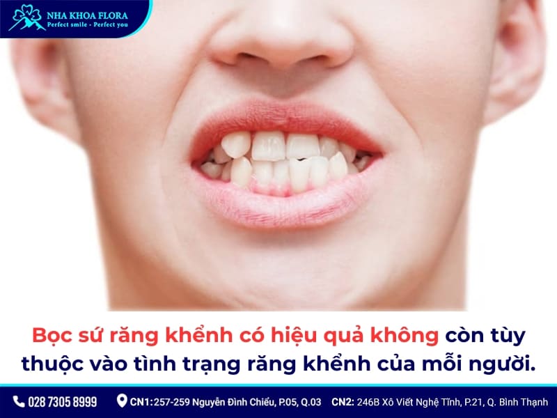 bọc răng sứ khểnh