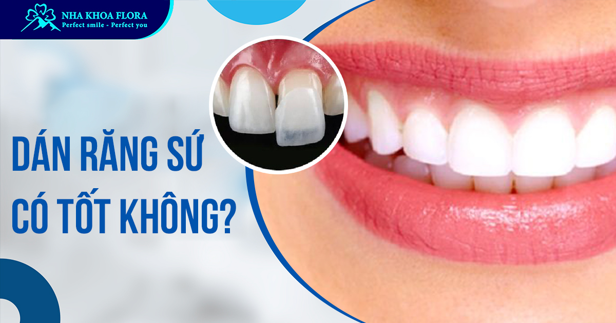 Dán răng sứ có tốt không? Bác sĩ Đắc Minh giải đáp!