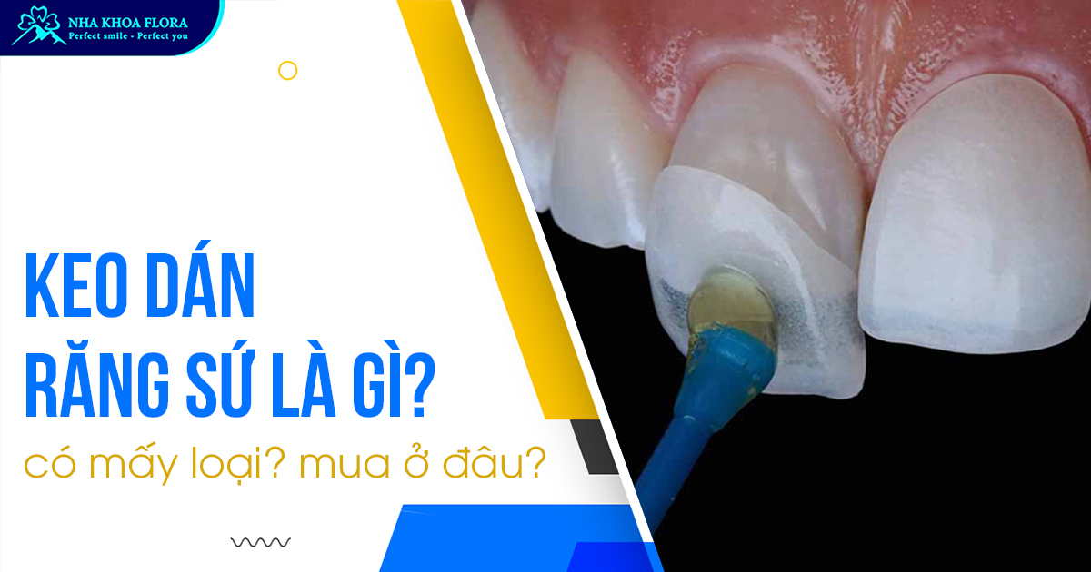 Keo dán răng sứ là gì? Có mấy loại? Mua ở đâu?