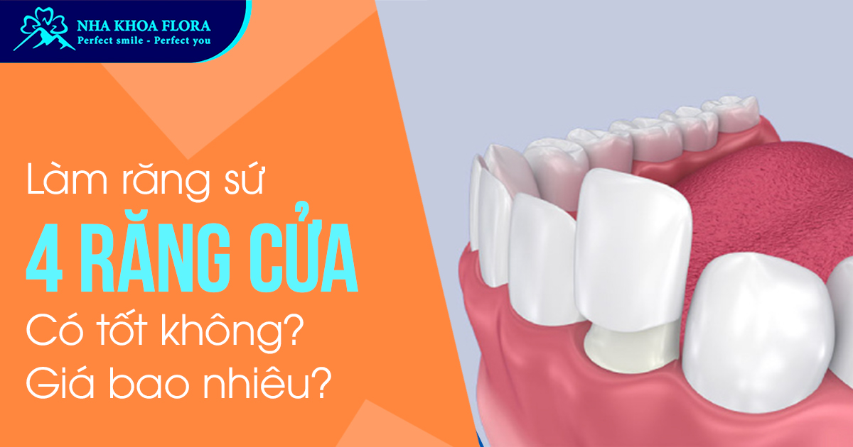 Làm răng sứ 4 răng cửa có tốt không? Giá bao nhiêu?