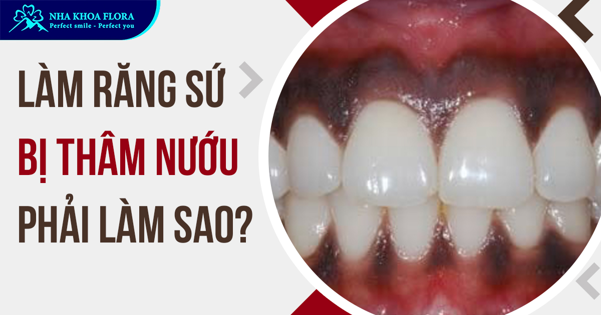 Làm răng sứ bị thâm nướu phải làm sao?