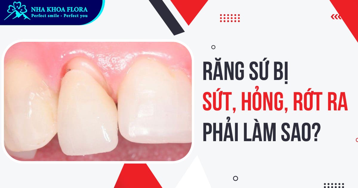 Răng sứ bị sứt, rớt ra: Nguyên nhân & cách điều trị hiệu quả