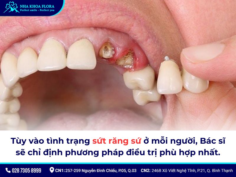 răng sứ bị sứt