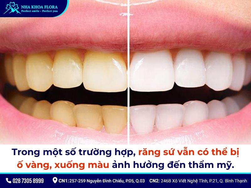 răng sứ có bị ố vàng không