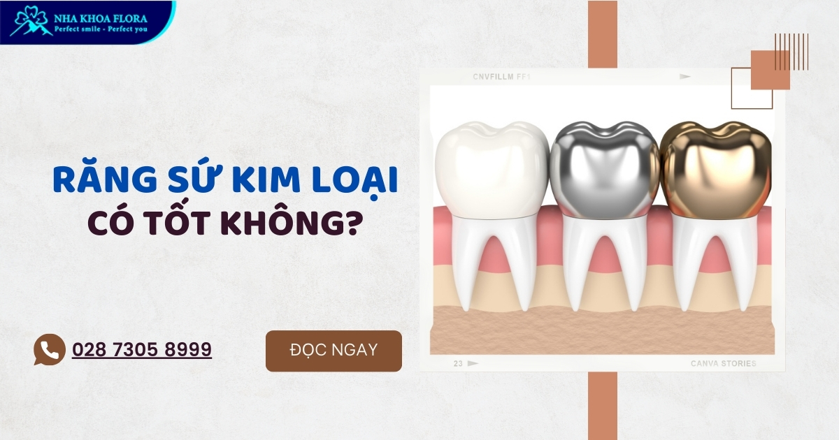 Răng sứ kim loại có tốt không? Chi phí làm hết bao nhiêu?