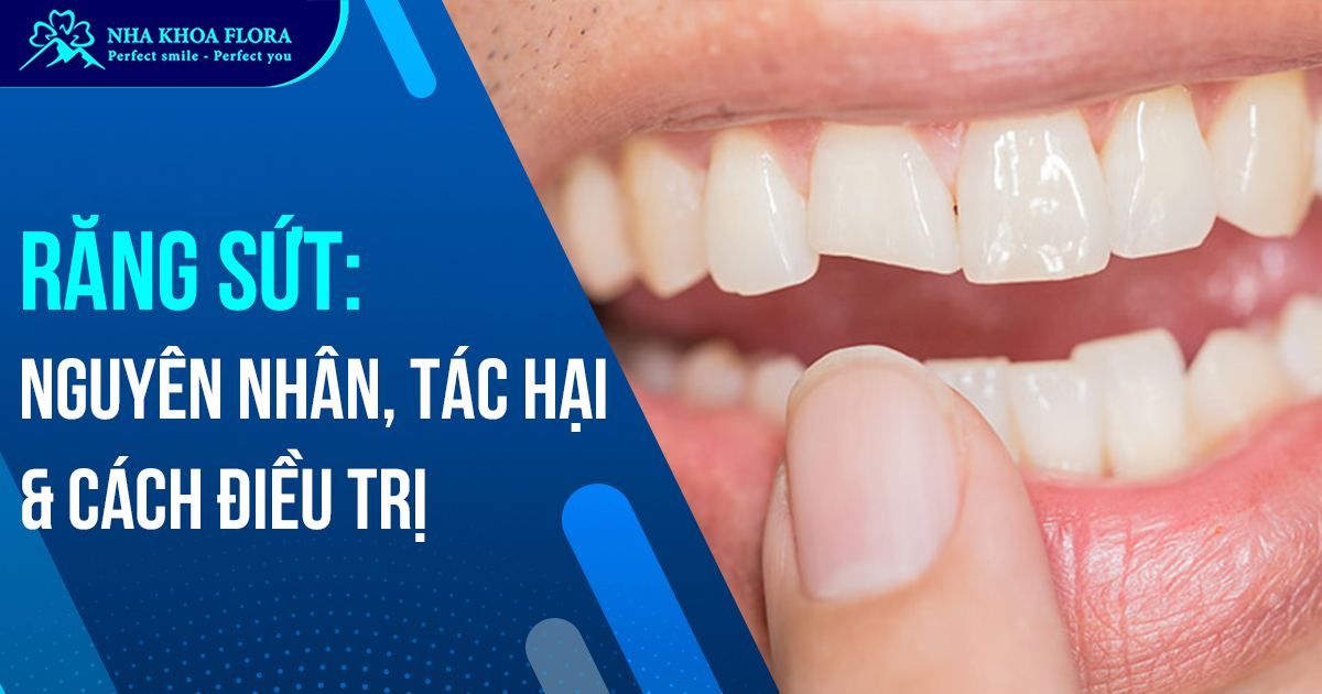 Răng sứt mẻ: Nguyên nhân, Tác hại & Cách điều trị