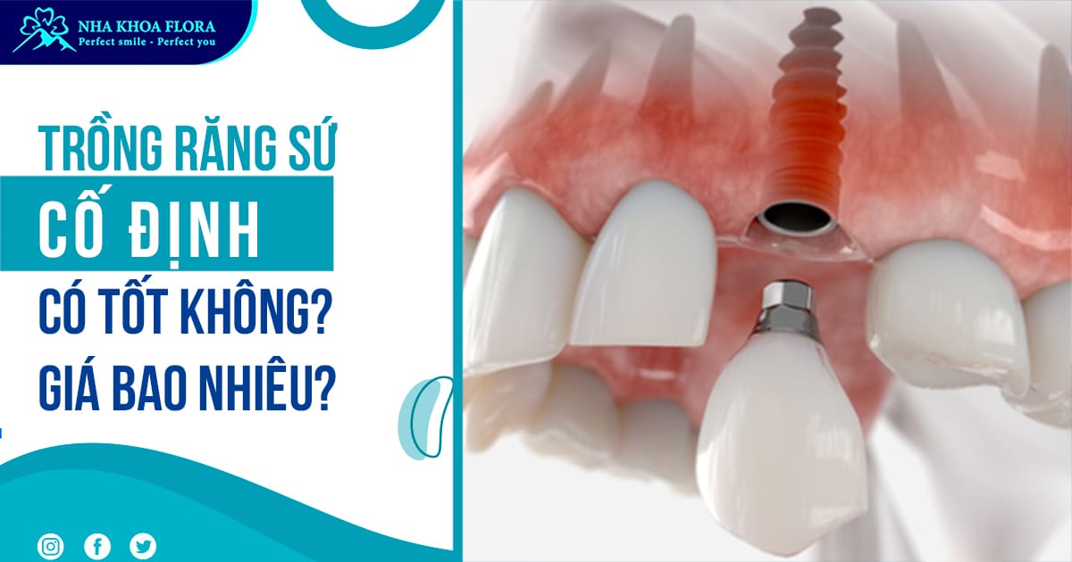 Trồng răng sứ cố định có tốt không? Giá bao nhiêu tiền?