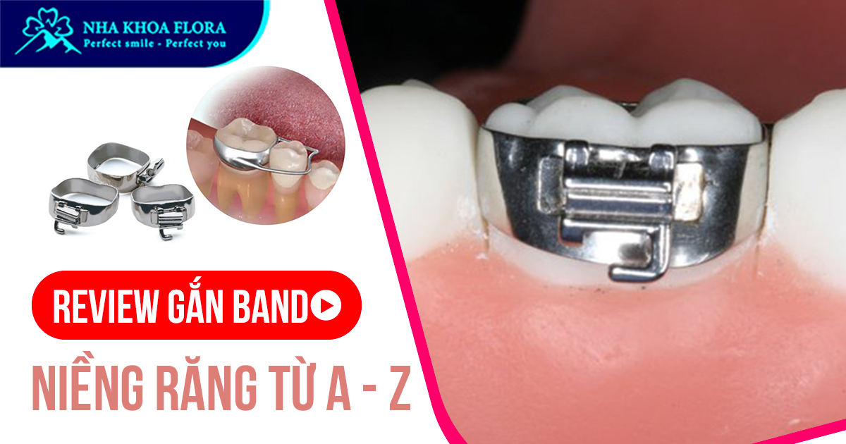 Band niềng răng là gì? Có bao nhiêu loại? Gắn có đau không?