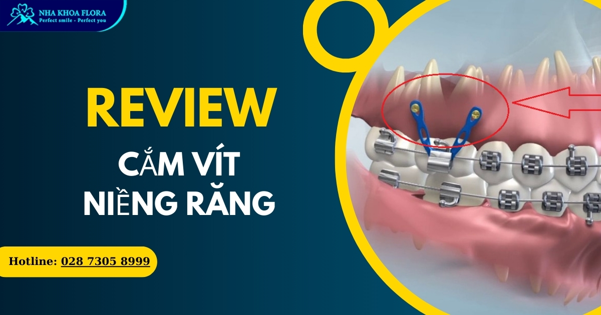 Bắt vít niềng răng là gì? Công dụng? Có gây đau không?