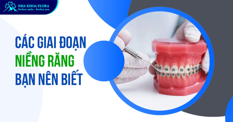 các giai đoạn niềng răng