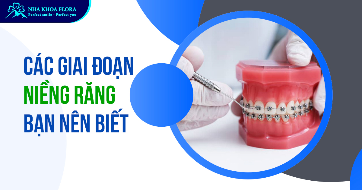 Các giai đoạn niềng răng bạn cần trải qua khi thực hiện