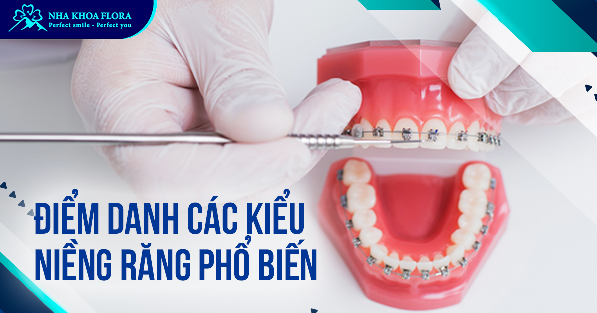 Tổng hợp các kiểu niềng răng phổ biến hiện nay