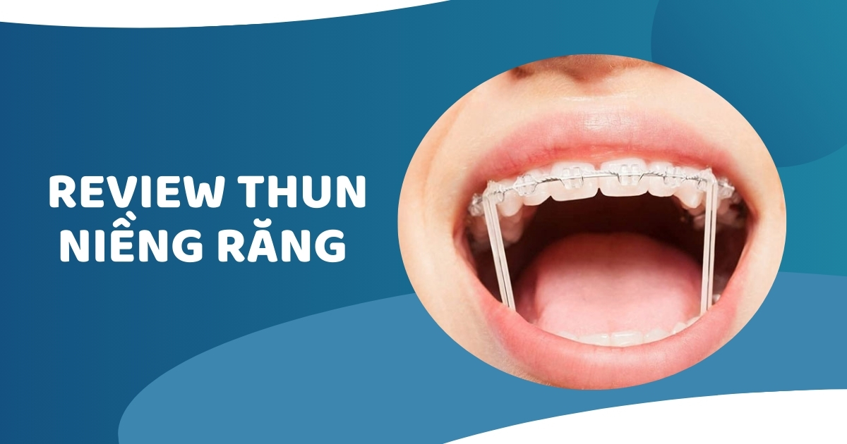 Thun niềng răng là gì? Có mấy loại? Nuốt có bị sao không?