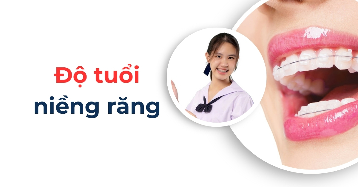 Độ tuổi niềng răng nào phù hợp và đem lại hiệu quả nhất?