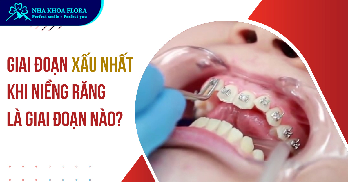 Giai đoạn xấu nhất khi niềng răng là lúc nào thưa Bác sĩ?