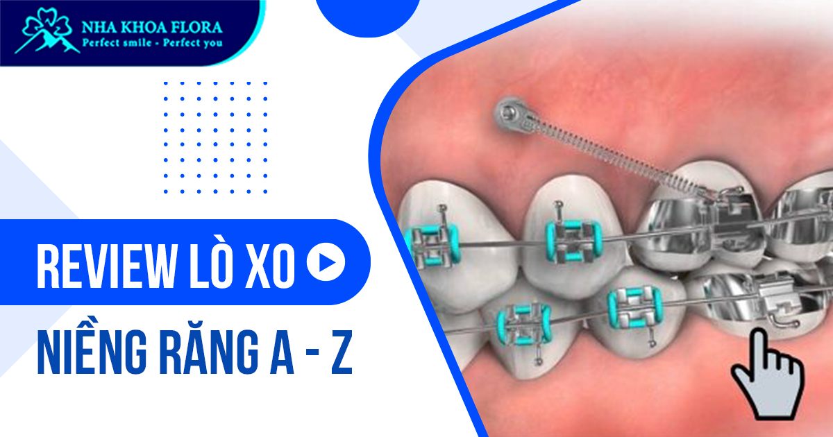 Lò xo niềng răng là gì? Công dụng và thời gian đeo bao lâu?