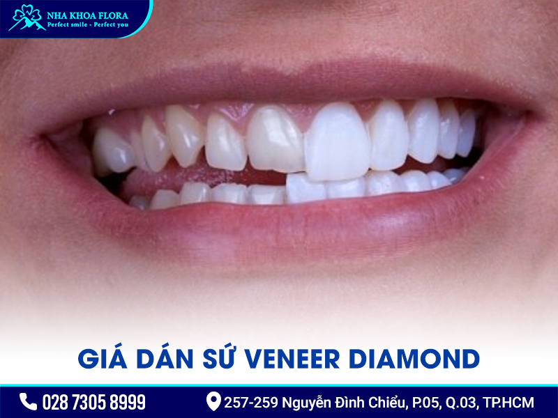 Mặt Dán Sứ Diamond Có Tốt Không? Giá Bao Nhiêu?