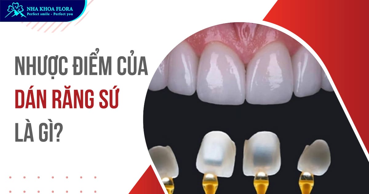 Nhược điểm của dán răng sứ bạn nên biết trước khi thực hiện