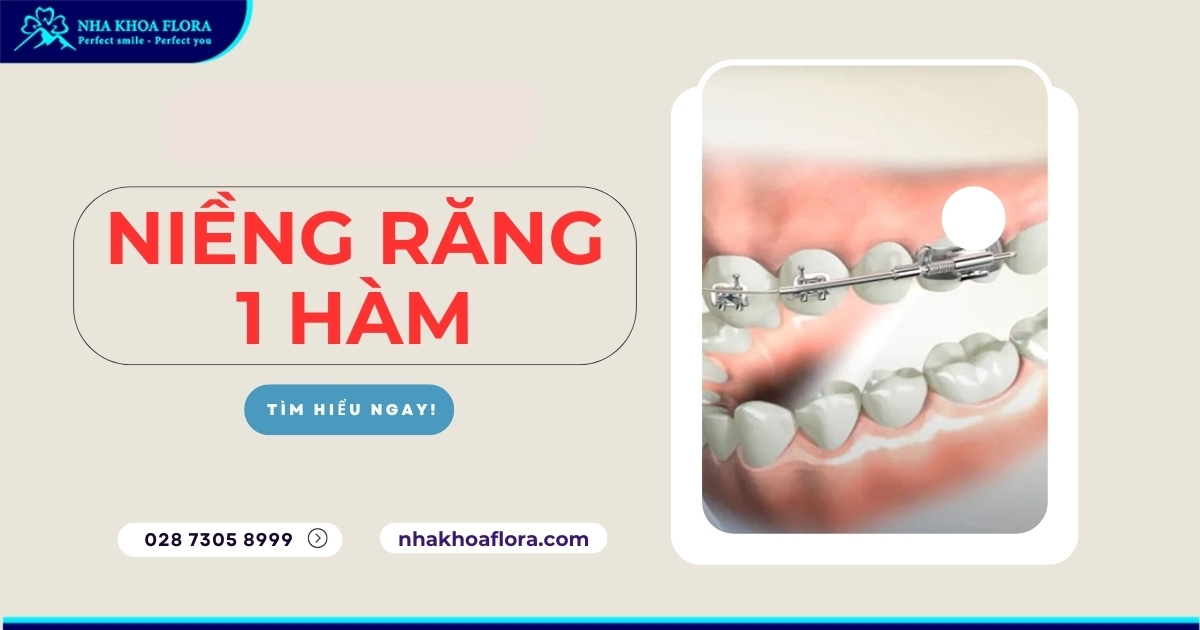 Niềng răng 1 hàm được không? Chi phí hết bao nhiêu tiền?