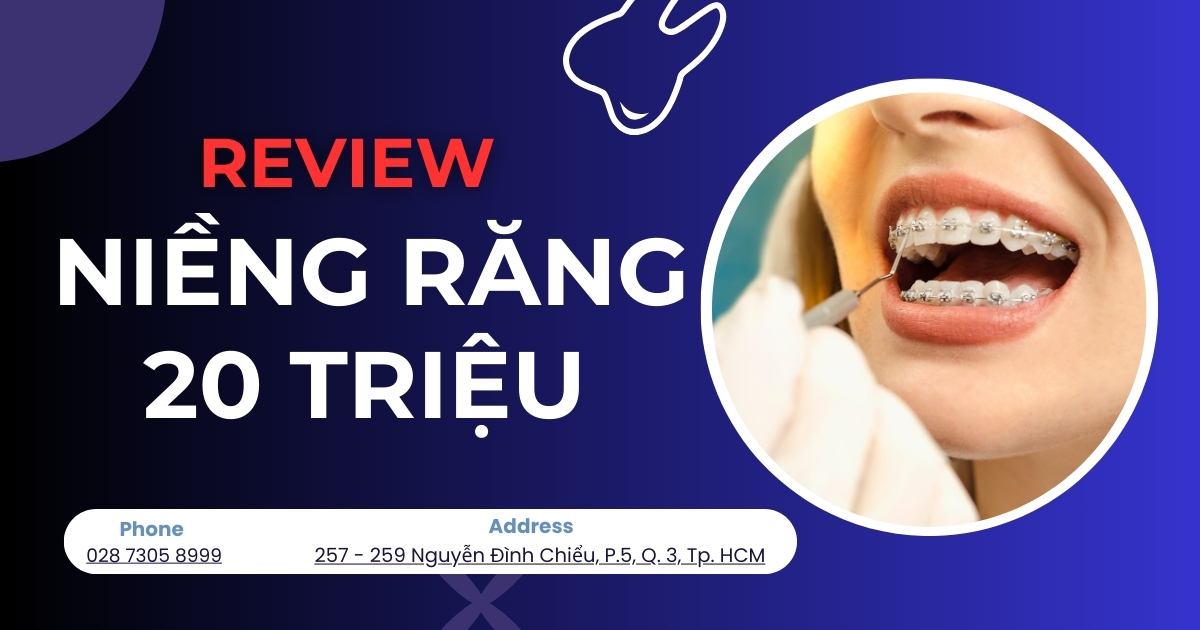 Review niềng răng 20 triệu có tốt và hiệu quả không?