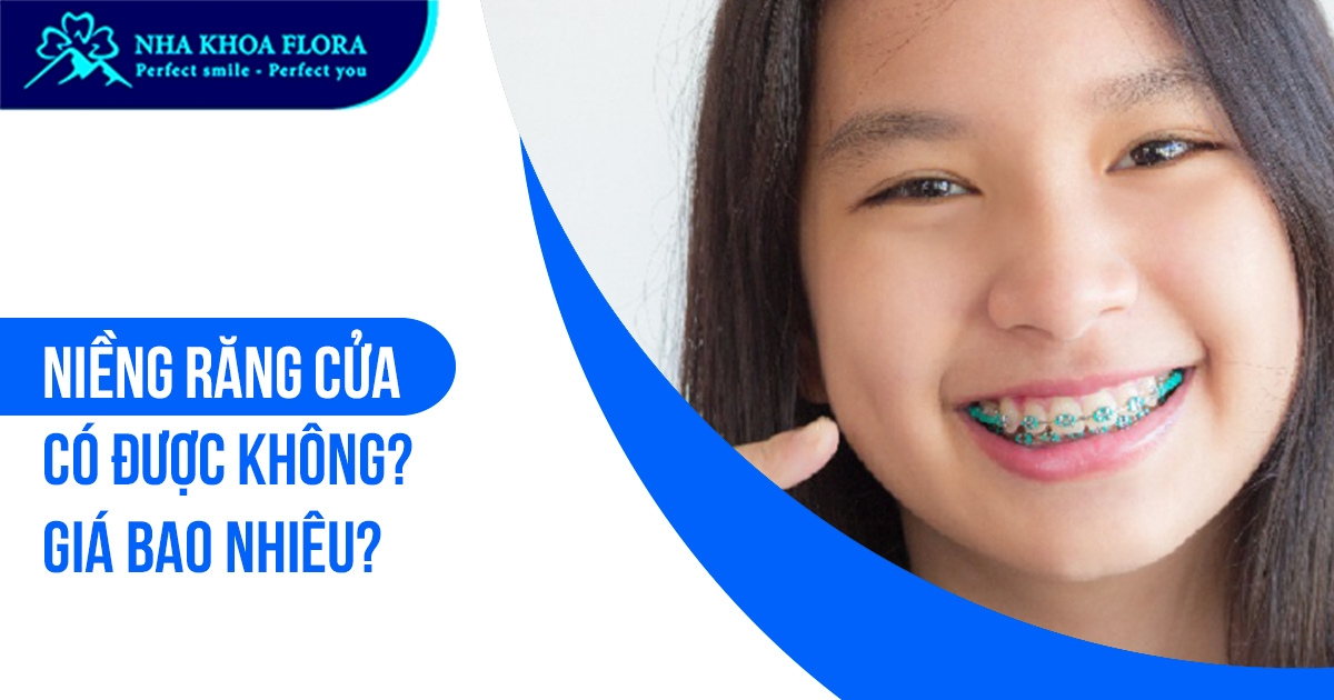 Niềng răng cửa có hiệu quả không? Mất bao lâu? Chi phí?