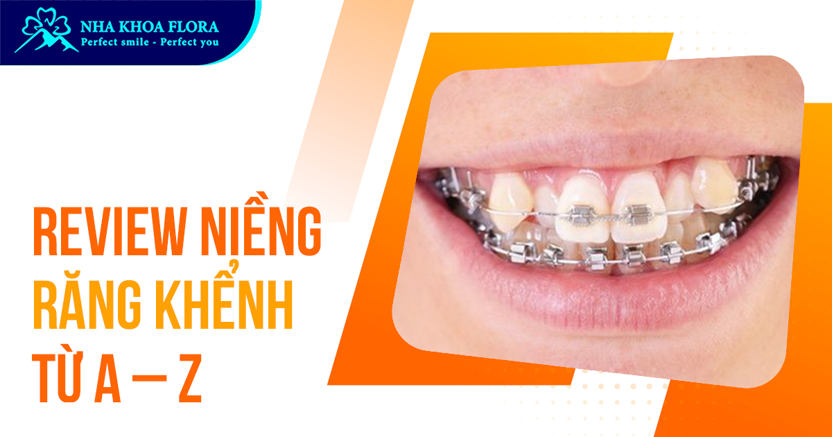 Niềng răng khểnh có nên không? Mất bao lâu? Bao nhiêu tiền?