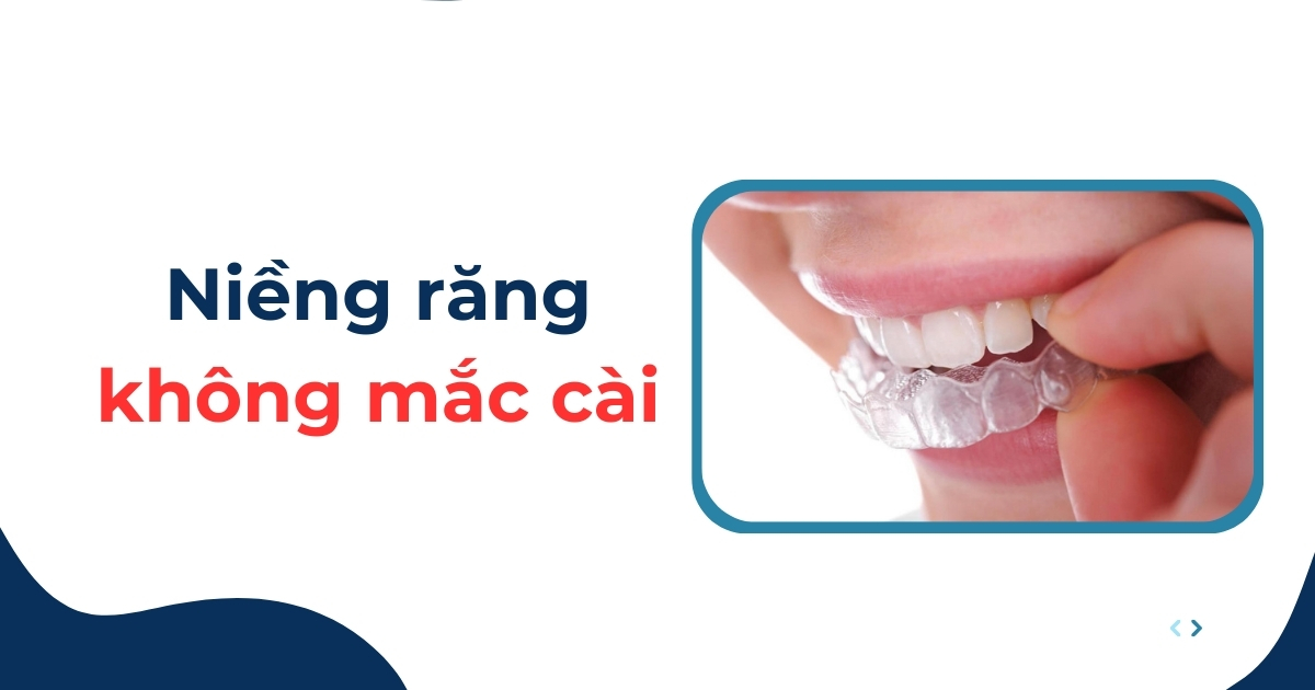 Niềng răng không mắc cài là gì? Có tốt không? Giá bao nhiêu?