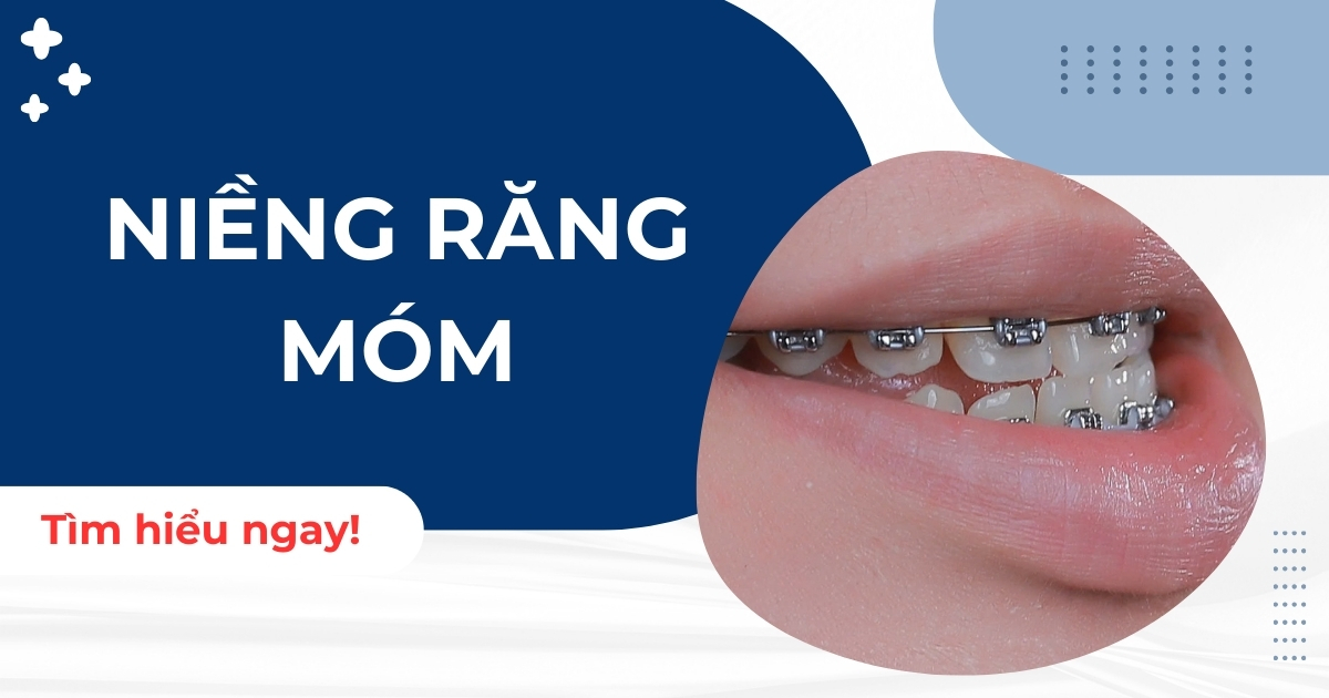 Niềng răng móm có nên không? Chi phí hết bao nhiêu tiền?
