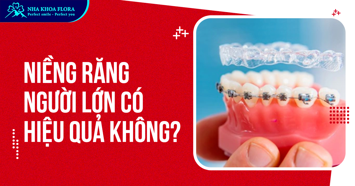 Niềng răng người lớn có hiệu quả không? giá bao nhiêu tiền?