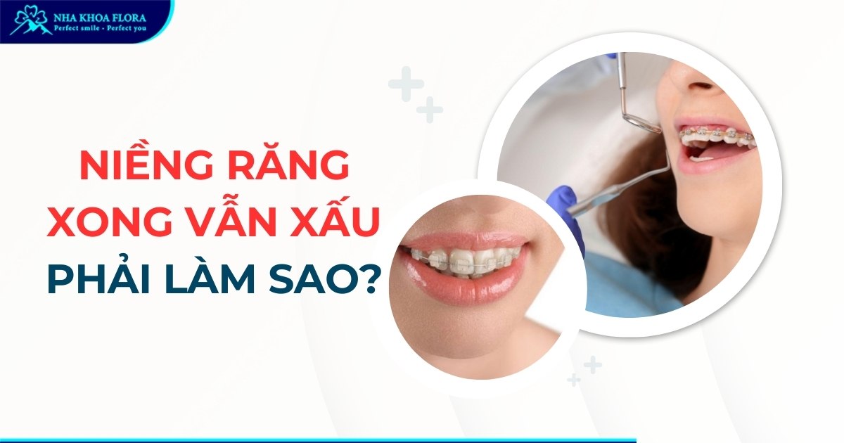 Niềng răng xong vẫn xấu: Nguyên nhân & Biện pháp khắc phục