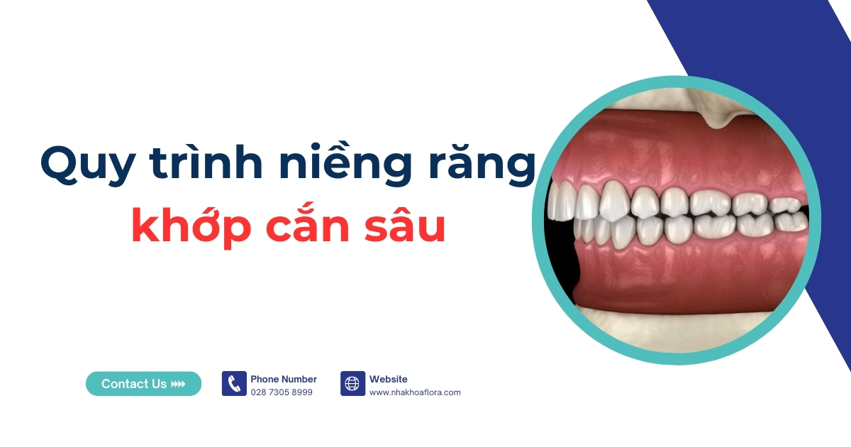 Quy trình niềng răng khớp cắn sâu sẽ diễn ra như thế nào?