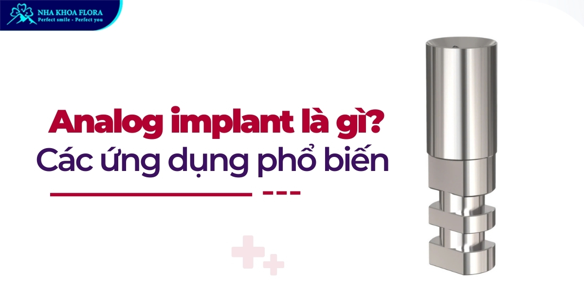 Analog implant là gì và các ứng dụng phổ biến