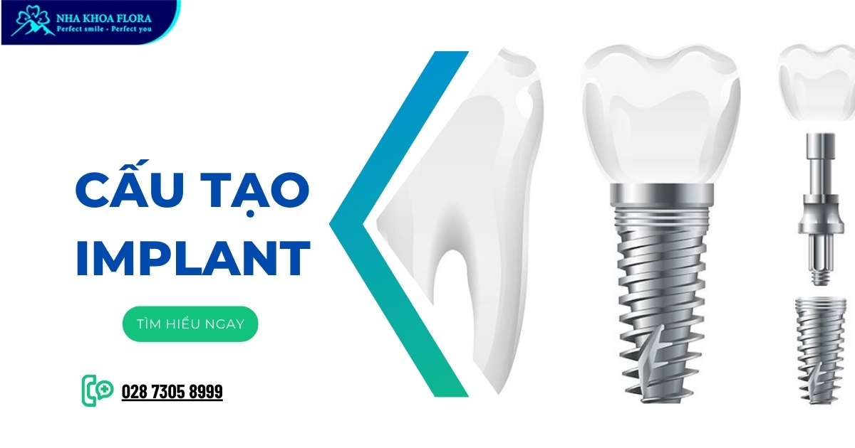 Cấu tạo Implant gồm những gì? Cách chọn như thế nào?