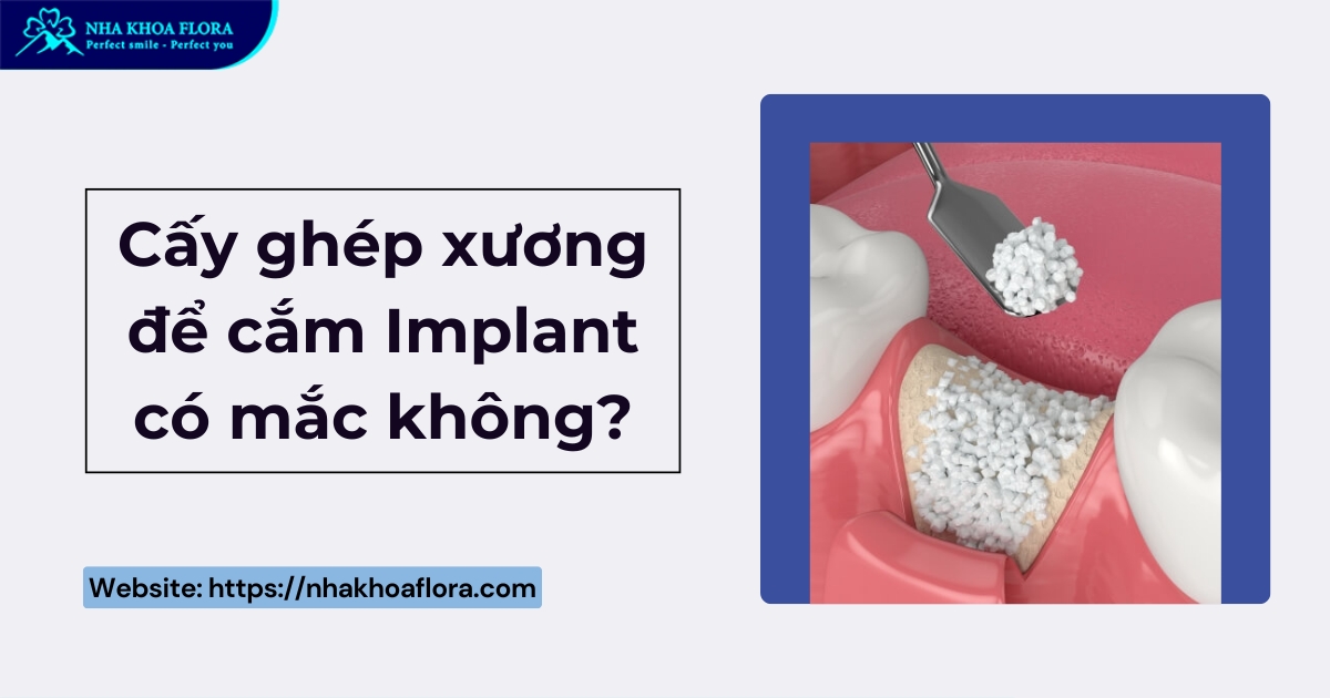 [Hỏi đáp]: Cấy ghép xương để cắm Implant có mắc không?