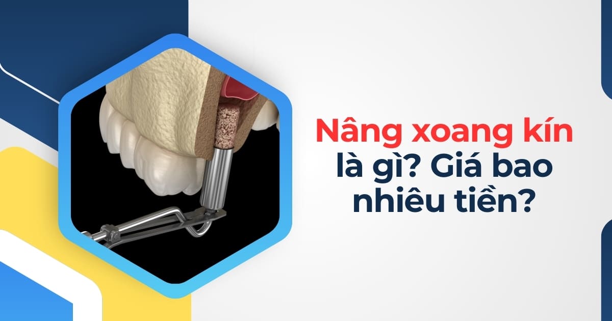 Nâng xoang kín là gì? Ai cần thực hiện? Giá bao nhiêu tiền?