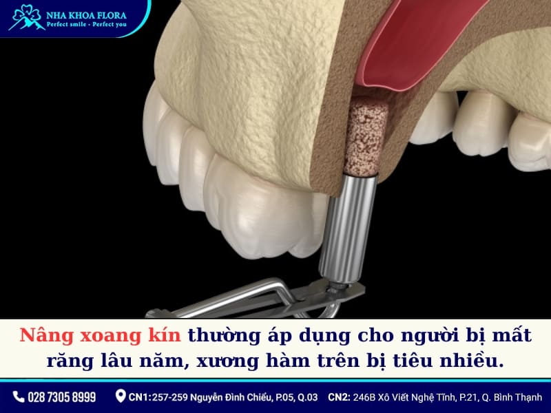 nâng xoang kín
