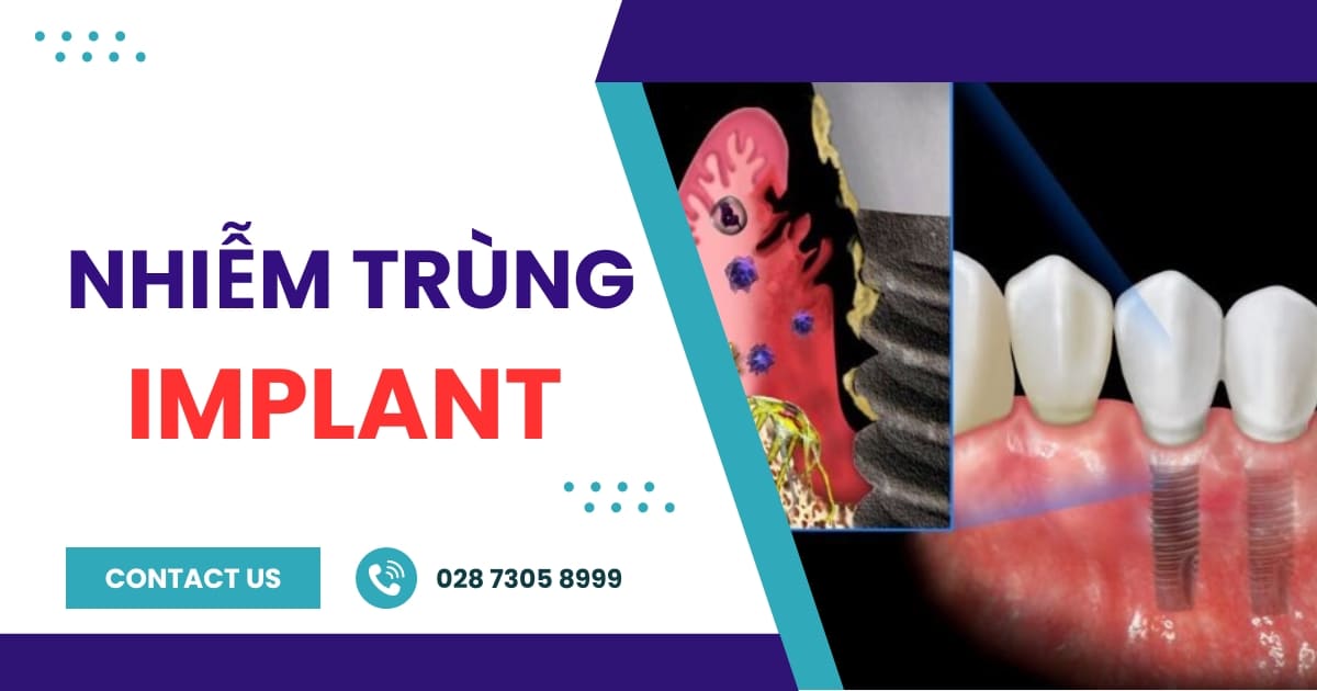 Nhiễm trùng Implant: Nguyên nhân, Dấu hiệu & Cách điều trị