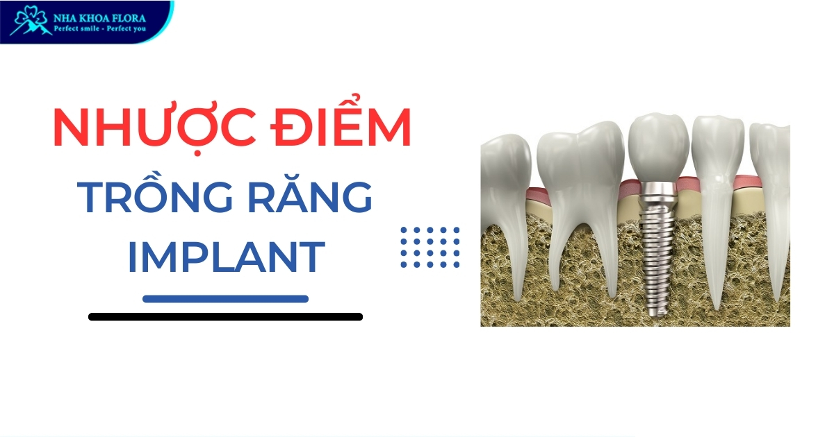 9 nhược điểm của trồng răng implant bạn cần nắm rõ