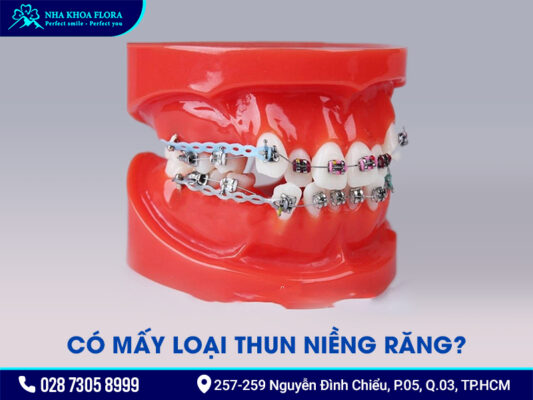 Niềng răng thun màu - ảnh 2