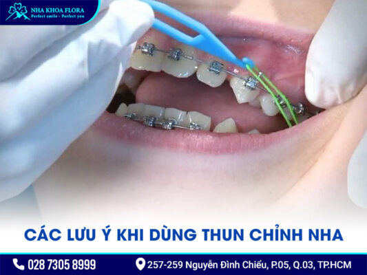 Niềng răng thun màu - ảnh 4