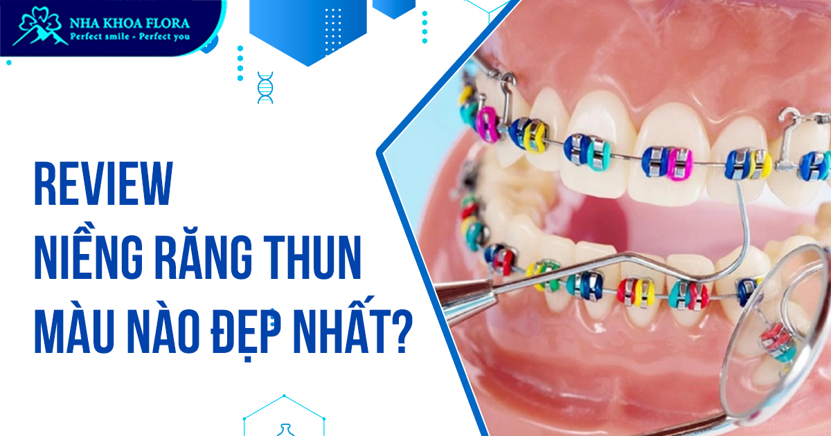 Review niềng răng thun màu nào đẹp nhất từ A – Z